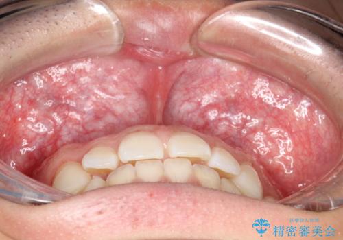 前歯の隙間がきになる インビザラインですきっ歯の治療の治療前