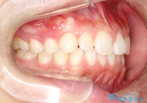 前歯の隙間がきになる　インビザラインですきっ歯の治療の治療前