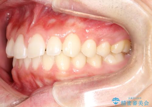 前歯の隙間がきになる インビザラインですきっ歯の治療の治療前