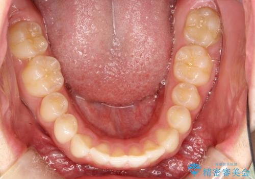 前歯の隙間がきになる　インビザラインですきっ歯の治療の治療前