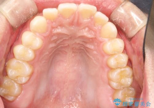 前歯の隙間がきになる インビザラインですきっ歯の治療の治療前