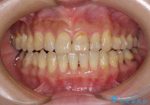 どこで咬んで良いのか分からない インビザラインでの咬み合わせの改善の治療中