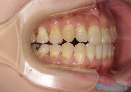 どこで咬んで良いのか分からない インビザラインでの咬み合わせの改善の治療中