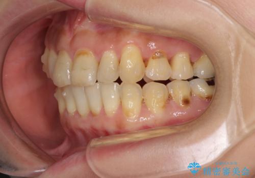 どこで咬んで良いのか分からない インビザラインでの咬み合わせの改善の治療中