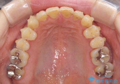 どこで咬んで良いのか分からない インビザラインでの咬み合わせの改善の治療中
