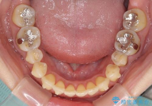 どこで咬んで良いのか分からない インビザラインでの咬み合わせの改善の治療中