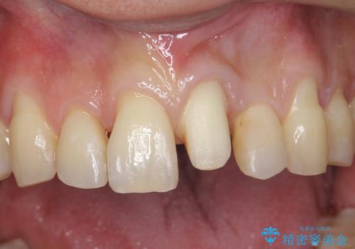 前歯の虫歯 矯正治療してからしっかり治すの治療中
