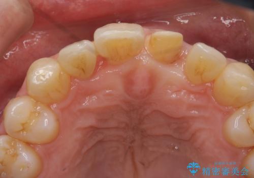 前歯の虫歯 矯正治療してからしっかり治すの治療中