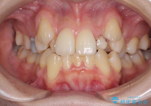 結婚式までに前歯をきれいにしたい 抜歯矯正とオールセラミッククラウンの症例 治療前