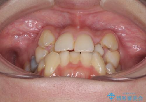 結婚式までに前歯をきれいにしたい 抜歯矯正とオールセラミッククラウンの治療前