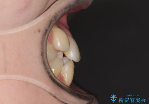 結婚式までに前歯をきれいにしたい 抜歯矯正とオールセラミッククラウンの治療前