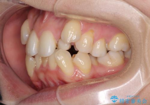 結婚式までに前歯をきれいにしたい　抜歯矯正とオールセラミッククラウンの治療前