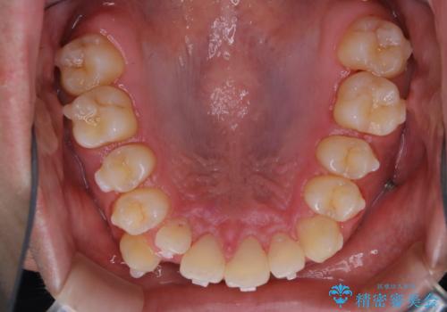 インビザラインでのマウスピース矯正中にクリーニングで口臭予防の治療後