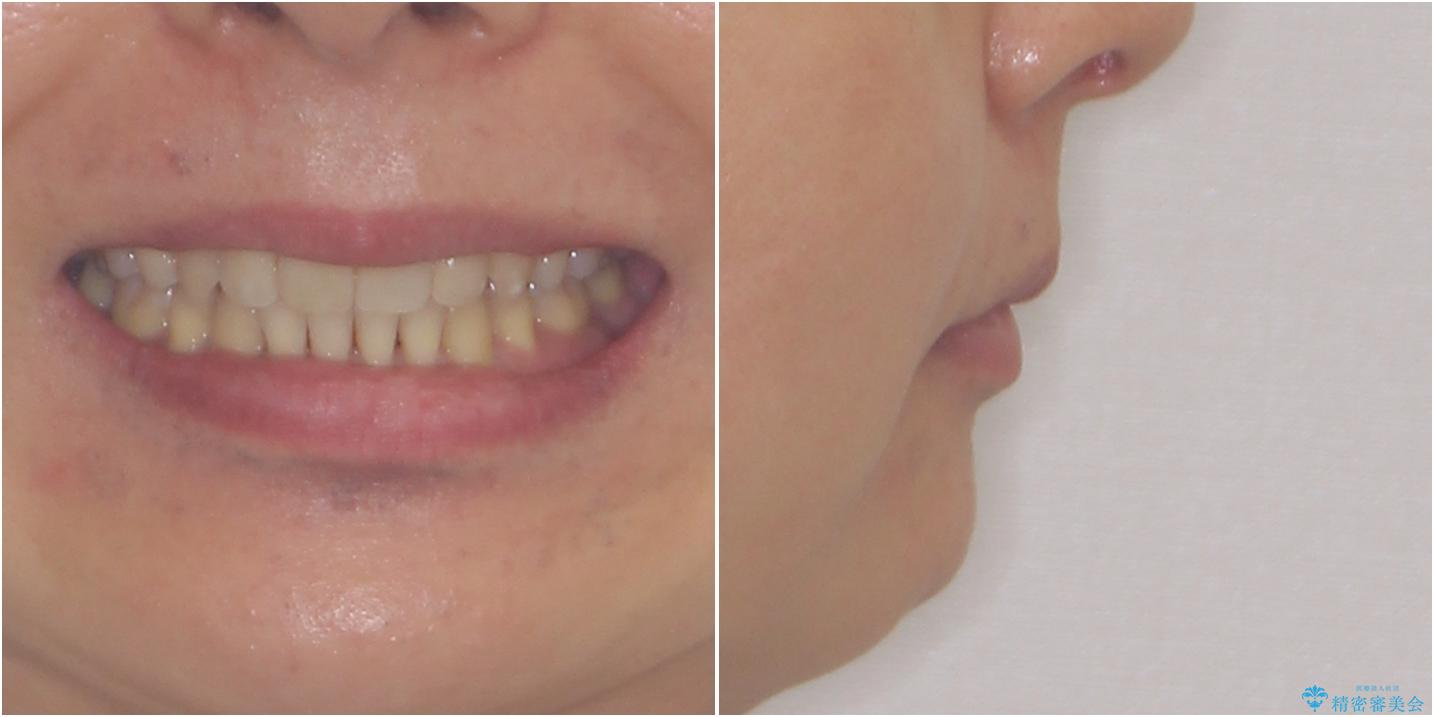 掃除しにくい前歯と閉じにくい口元　目立たないワイヤー装置での抜歯矯正の治療後（顔貌）
