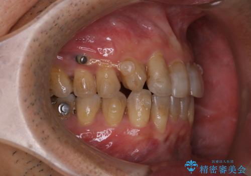 インビザライン中にステインを綺麗にOFFの治療前