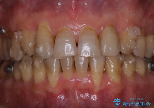 インビザライン中にステインを綺麗にOFFの治療前