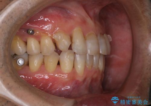 インビザライン中にステインを綺麗にOFFの治療後