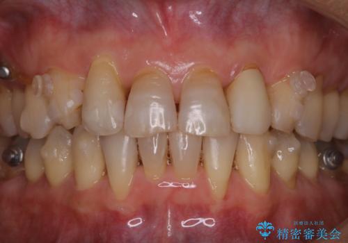 インビザライン中にステインを綺麗にOFFの治療後