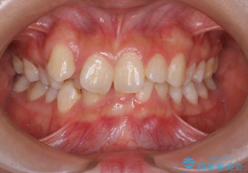 【インビザライン】抜歯矯正の症例 治療前