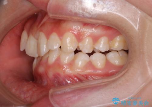 【インビザライン】抜歯矯正の治療前