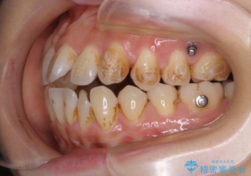 矯正中も定期的にクリーニングをの治療前