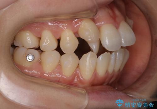 矯正中も定期的にクリーニングをの治療後