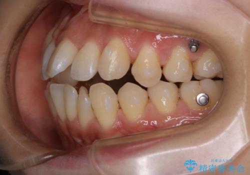 矯正中も定期的にクリーニングをの治療後