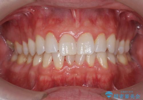 オフィスホワイトニングで、歯を白く爽やかな印象に!の症例 治療前
