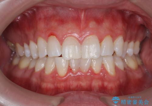 オフィスホワイトニングで、歯を白く爽やかな印象に!の症例 治療後