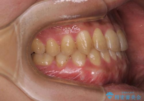 矯正治療を終えてのクリーニングの治療前