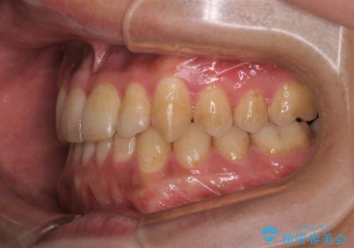 矯正治療を終えてのクリーニングの治療前