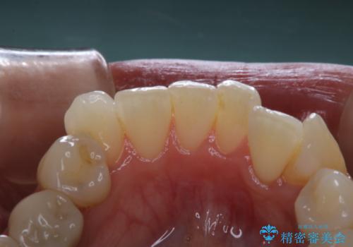 invisalignの型取り前に歯のクリーニングの治療前