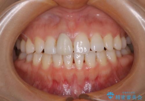歯と歯の間の色が気になる 1日で綺麗に落とすの治療前