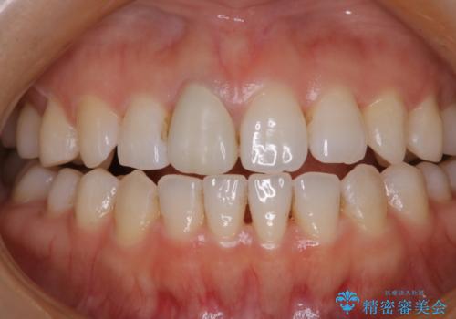 歯と歯の間の色が気になる　1日で綺麗に落とすの症例 治療前