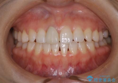 歯と歯の間の色が気になる　1日で綺麗に落とすの治療後