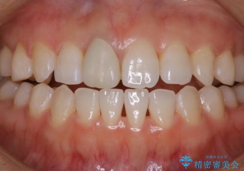 歯と歯の間の色が気になる　1日で綺麗に落とすの症例 治療後