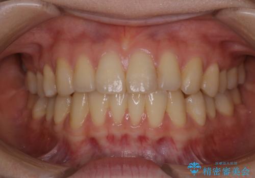 マウスピース矯正終了後にPMTCでよりきれいな歯にの治療前