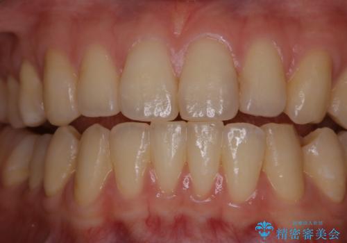 マウスピース矯正終了後にPMTCでよりきれいな歯にの症例 治療前