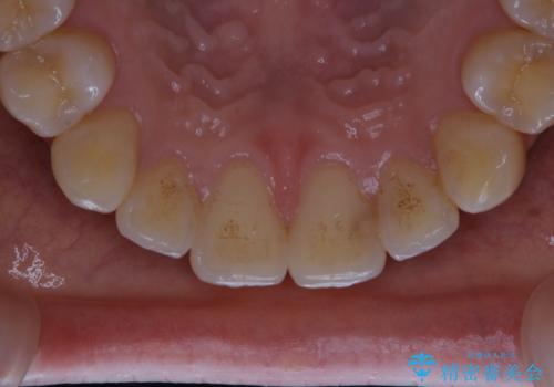 マウスピース矯正終了後にPMTCでよりきれいな歯にの治療前