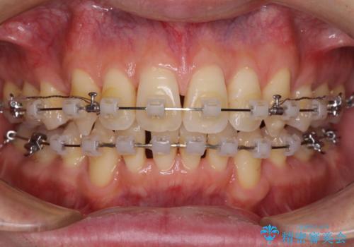 掃除しにくい前歯と閉じにくい口元　目立たないワイヤー装置での抜歯矯正の治療中