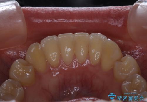 マウスピース矯正終了後にPMTCでよりきれいな歯にの治療前