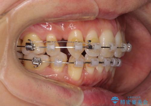 掃除しにくい前歯と閉じにくい口元 目立たないワイヤー装置での抜歯矯正の治療中