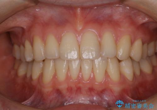マウスピース矯正終了後にPMTCでよりきれいな歯にの治療後