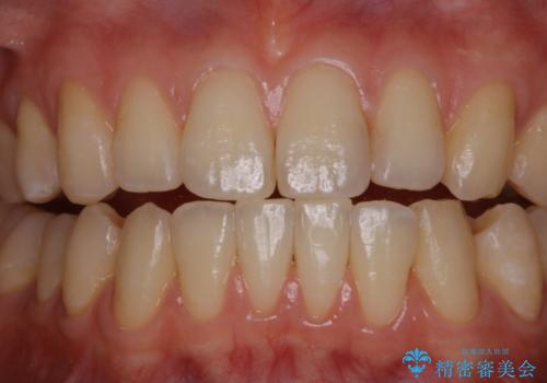マウスピース矯正終了後にPMTCでよりきれいな歯にの症例 治療後