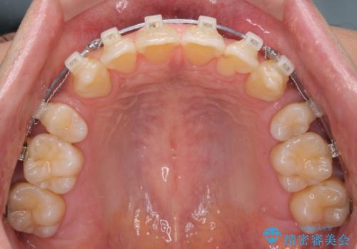 掃除しにくい前歯と閉じにくい口元 目立たないワイヤー装置での抜歯矯正の治療中