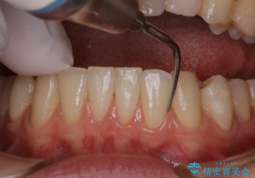 マウスピース矯正終了後にPMTCでよりきれいな歯に
