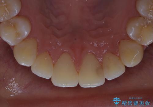 マウスピース矯正終了後にPMTCでよりきれいな歯にの治療後