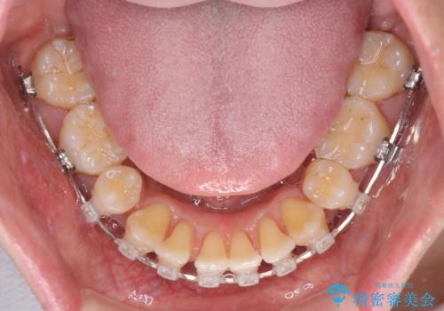 掃除しにくい前歯と閉じにくい口元 目立たないワイヤー装置での抜歯矯正の治療中