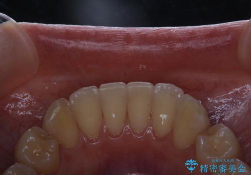 マウスピース矯正終了後にPMTCでよりきれいな歯にの治療後
