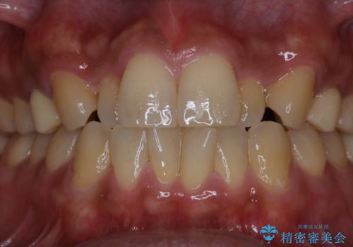 PMTCで笑った時の口元を自然に明るくしたいの治療前